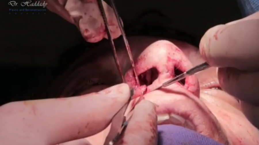 فیلم عمل بینی اتاق عمل پاکسازی پوست