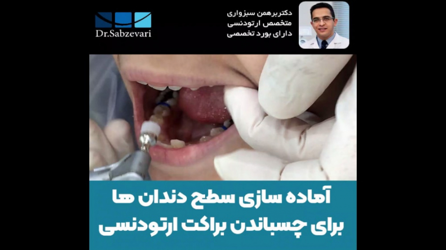 آماده سازی سطح دندان ها برای چسباندن براکت ارتودنسی 1 دکتر برهمن سبزواری - متخصص ارتودنسی - مشهد