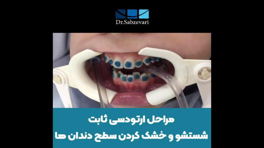 مراحل ارتودنسی ثابت (شستشو و خشک کردن سطح دندان ها) دکتر برهمن سبزواری - متخصص ارتودنسی - مشهد