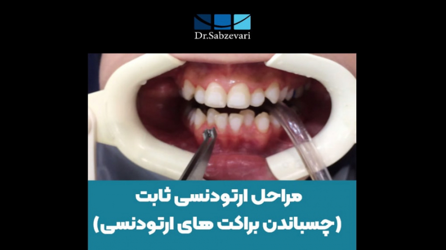 مراحل ارتودنسی ثابت (چسباندن براکت های ارتودنسی) دکتر برهمن سبزواری - متخصص ارتودنسی - مشهد