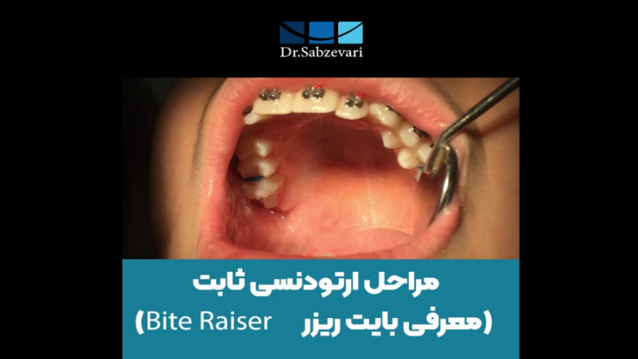 مراحل ارتو.دنسی ثابت(معرفی بایت ریزر) دکتر برهمن سبزواری - متخصص ارتودنسی - مشهد