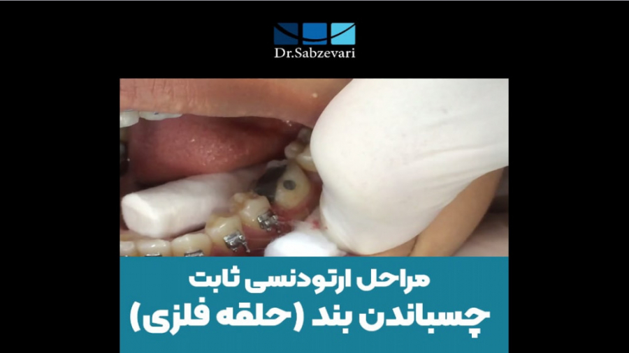 مراحل ارتو.دنسی ثابت؛ چسباندن بند(حلقه فلزی) دکتر برهمن سبزواری - متخصص ارتودنسی - مشهد