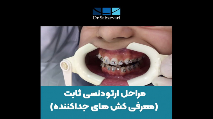 مراحل ارتو.دنسی ثابت(معرفی کش های جداکننده) دکتر برهمن سبزواری - متخصص ارتودنسی - مشهد