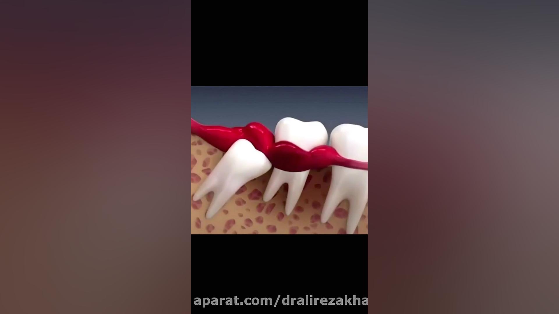 عوارض دندان عقل.دکترعلیرضاخدیوی متخصص ارتودنسی دکتر علیرضا خدیوی