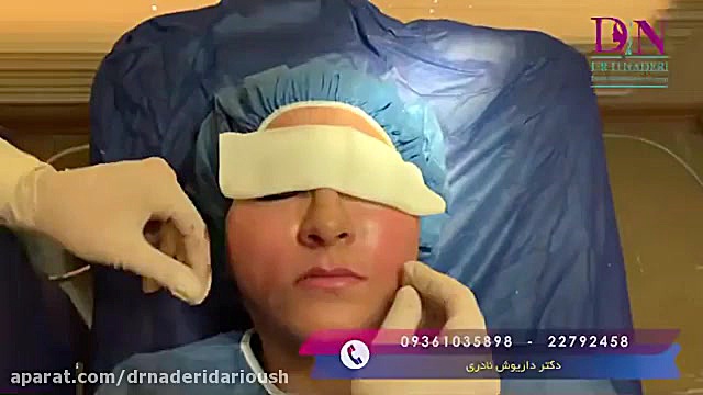 فیلم واقعی تزریق چربی به گونه و خط خنده CUT&RUN