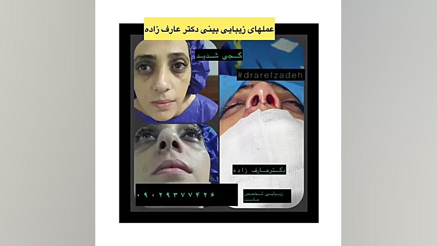 دکتراسماعیل عارف زاده، متخصص گوش، حلق و بینی، ساری پیلینگ شیمیایی