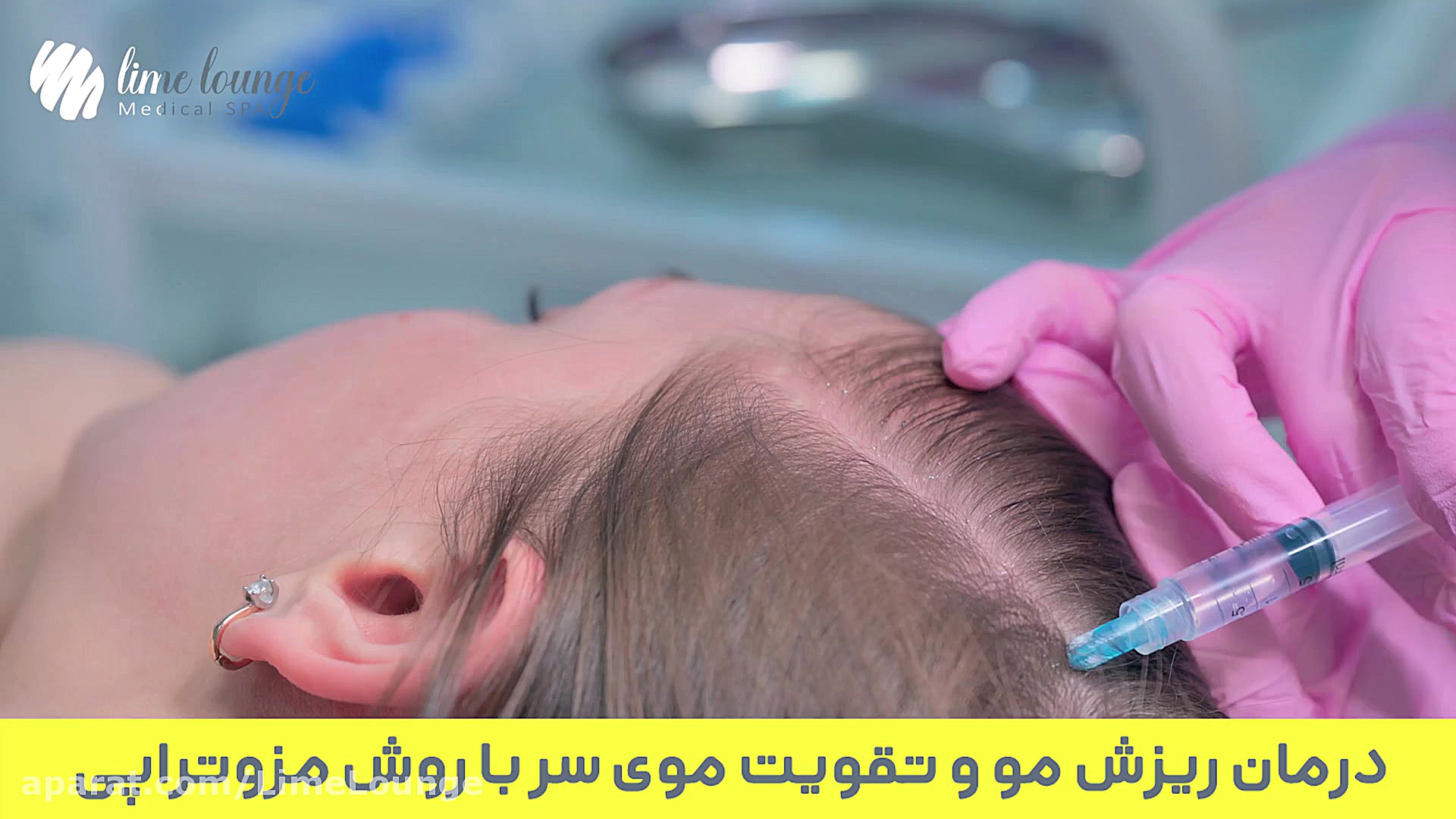 درمان ریزش مو و تقویت موی سر با روش مزوتراپی | لایم لانژ HIDA Scan
