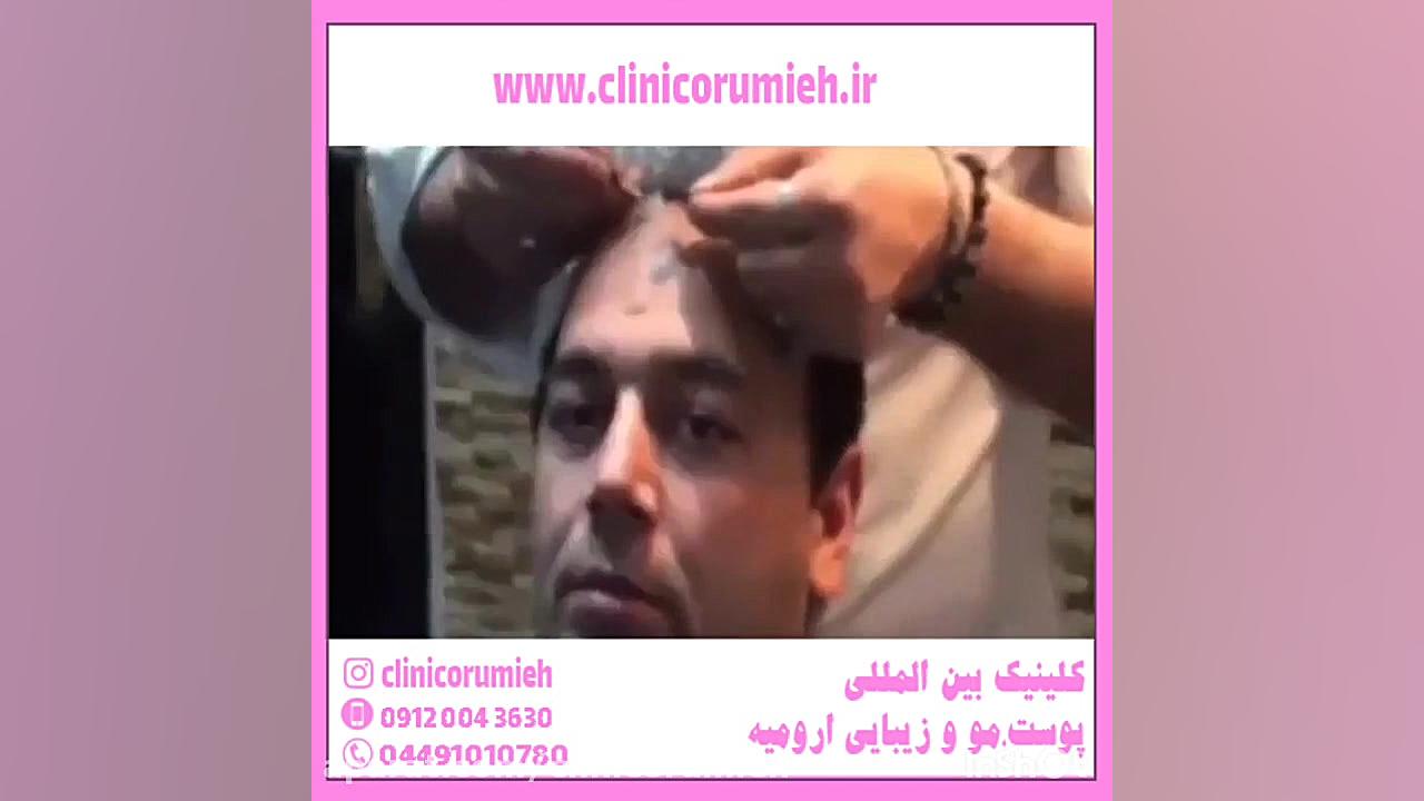 نحوه شستن موها و شامپو مناسب بعد از کاشت مو آر اف فرکشنال