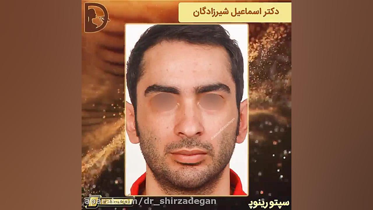 سپتورینوپلاستی دکتر اسماعیل شیرزادگان
