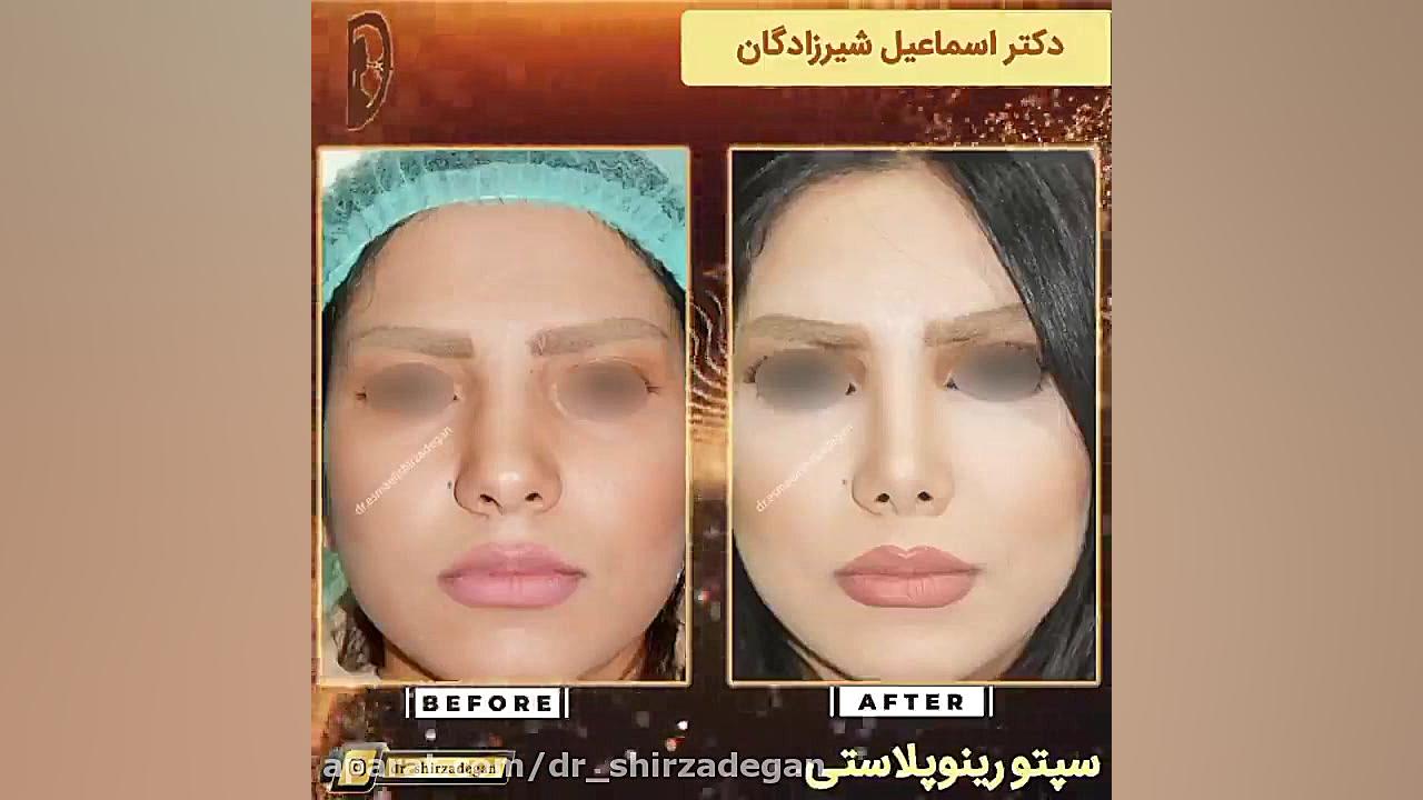 سپتورینوپلاستی دکتر اسماعیل شیرزادگان