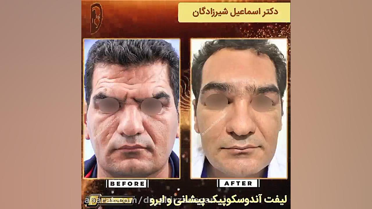 لیفت آندوسکوپیک پیشانی و ابرو دکتر اسماعیل شیرزادگان