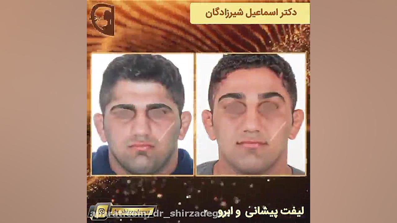 فیلم لیفت پیشانی و ابرو دکتر اسماعیل شیرزادگان