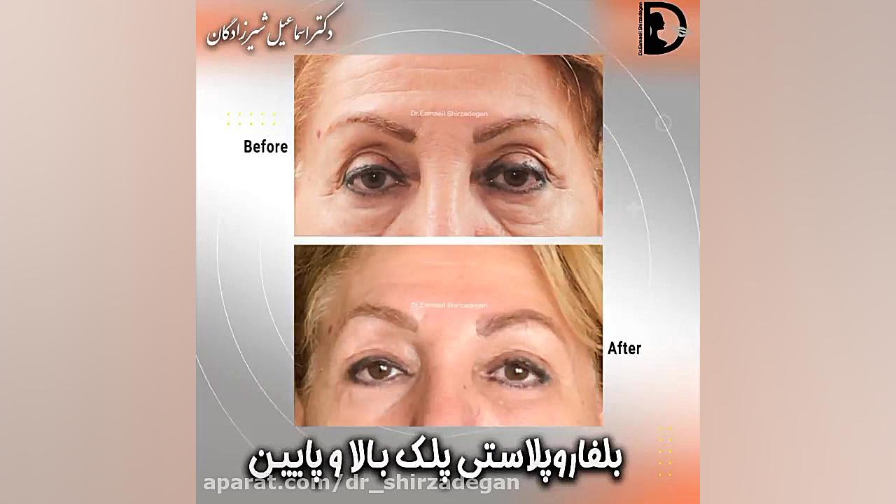 جراحی پلک بالا و پایین دکتر اسماعیل شیرزادگان