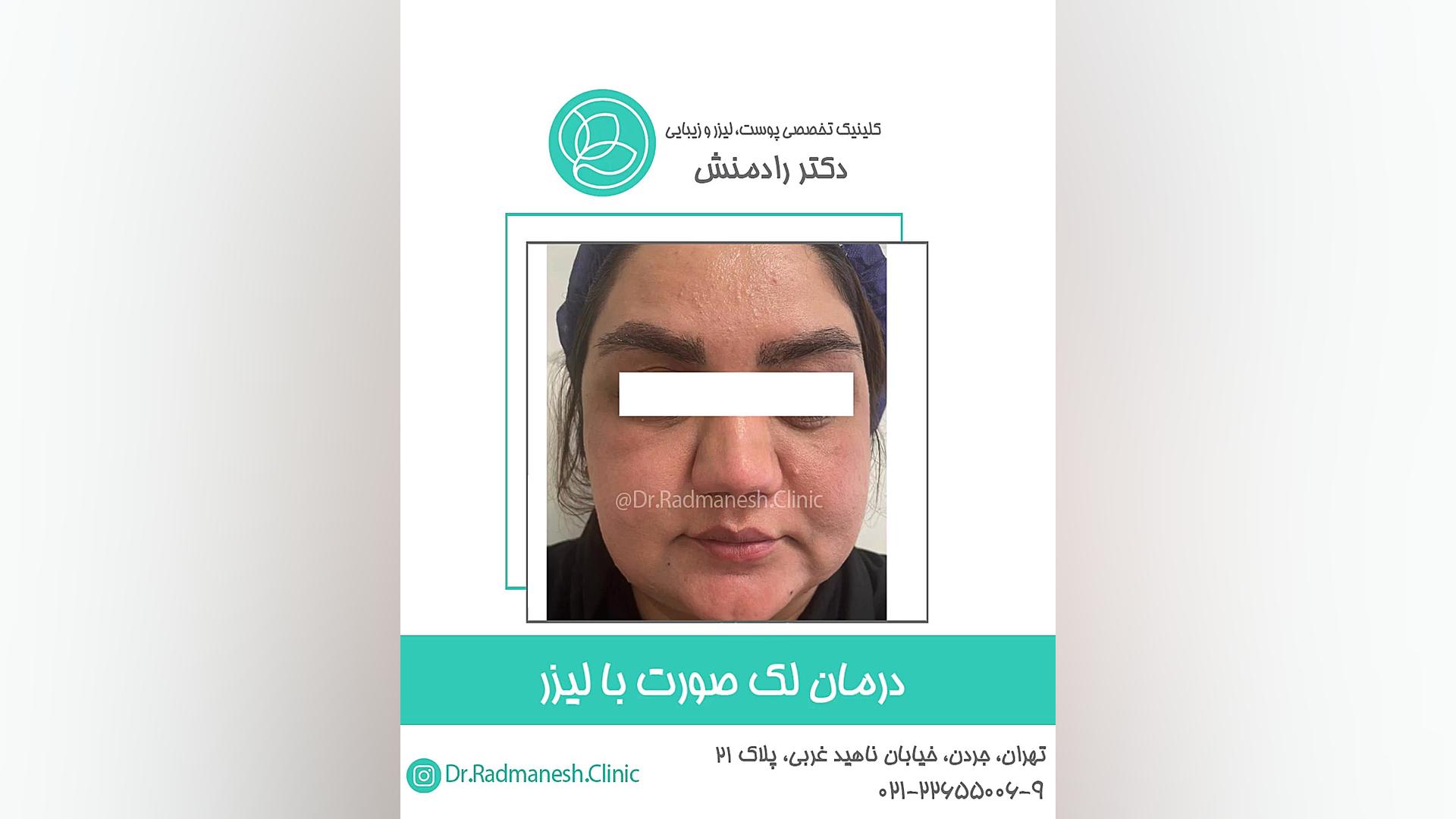 درمان لک صورت با لیزر اکستنشن تاج دندان