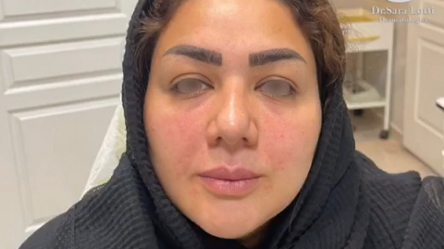 تزریق فیلر زیر چشم و خط خنده دکتر سار ا لطفی