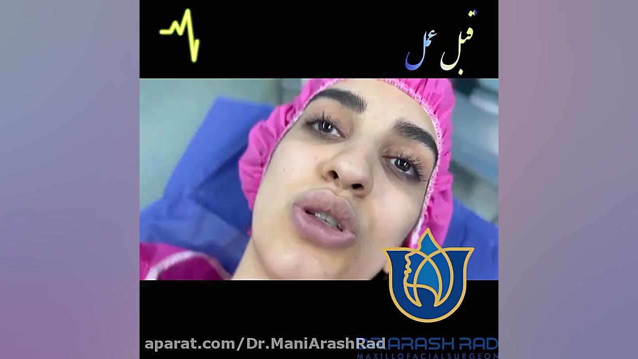 رینوپلاستی دکتر مانی آرش راد جراح فك و صورت