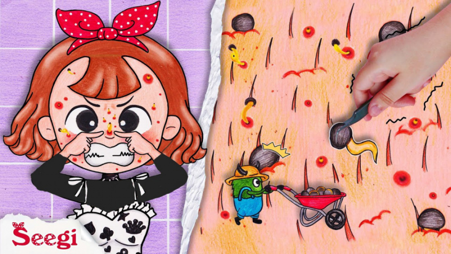 درمان جوش سر سیاه بینی __ پرنسس باربی مزوتراپی