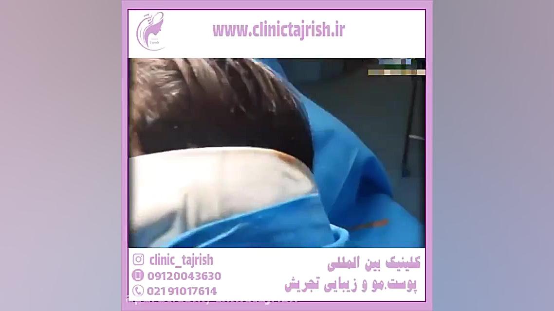 اتوپلاستی چیست و چگونه انجام می شود؟ pCO2