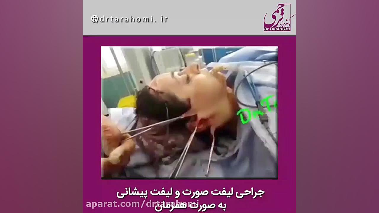 جراحی لیفت صورت و لیفت پیشانی بصورت همزمان جراحی فک