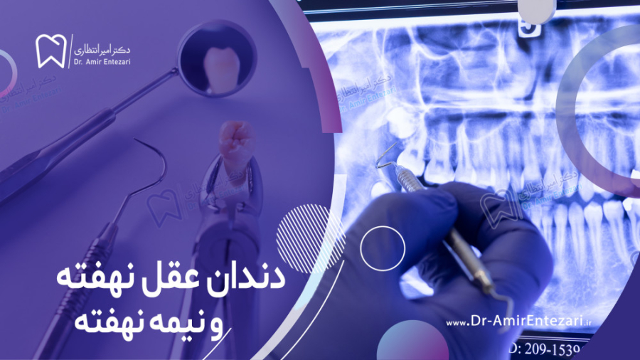 دندان عقل نهفته و نیمه نهفته دکتر امیر انتظاری