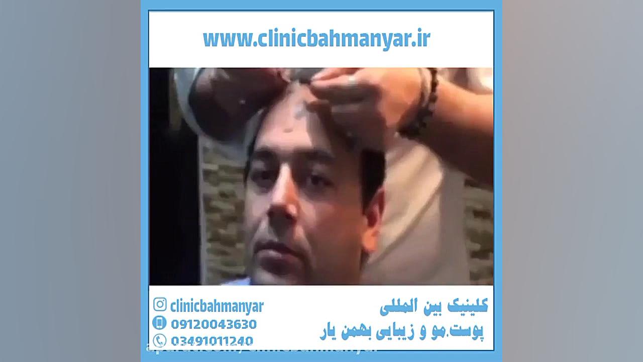 نحوه شستن موها و شامپو مناسب بعد از کاشت مو مزوتراپی