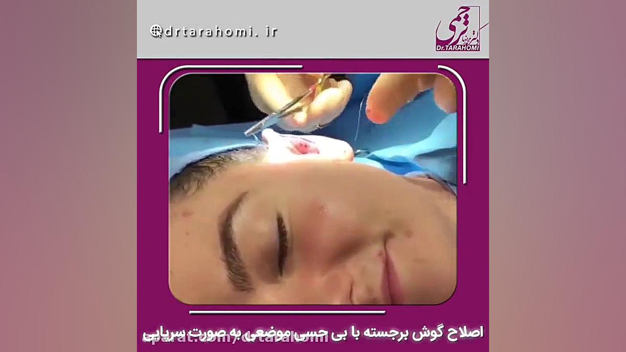 اصلاح گوش برجسته با بی حسی موضعی و بصورت سرپایی تزریق بوتاکس