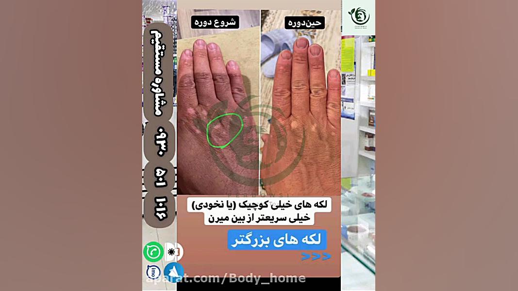 ویتیلیگو درمان شد تصاویر افراد شده بیماری پیسی برص بهاق vitiligo قسمت 5 سحر قریشی