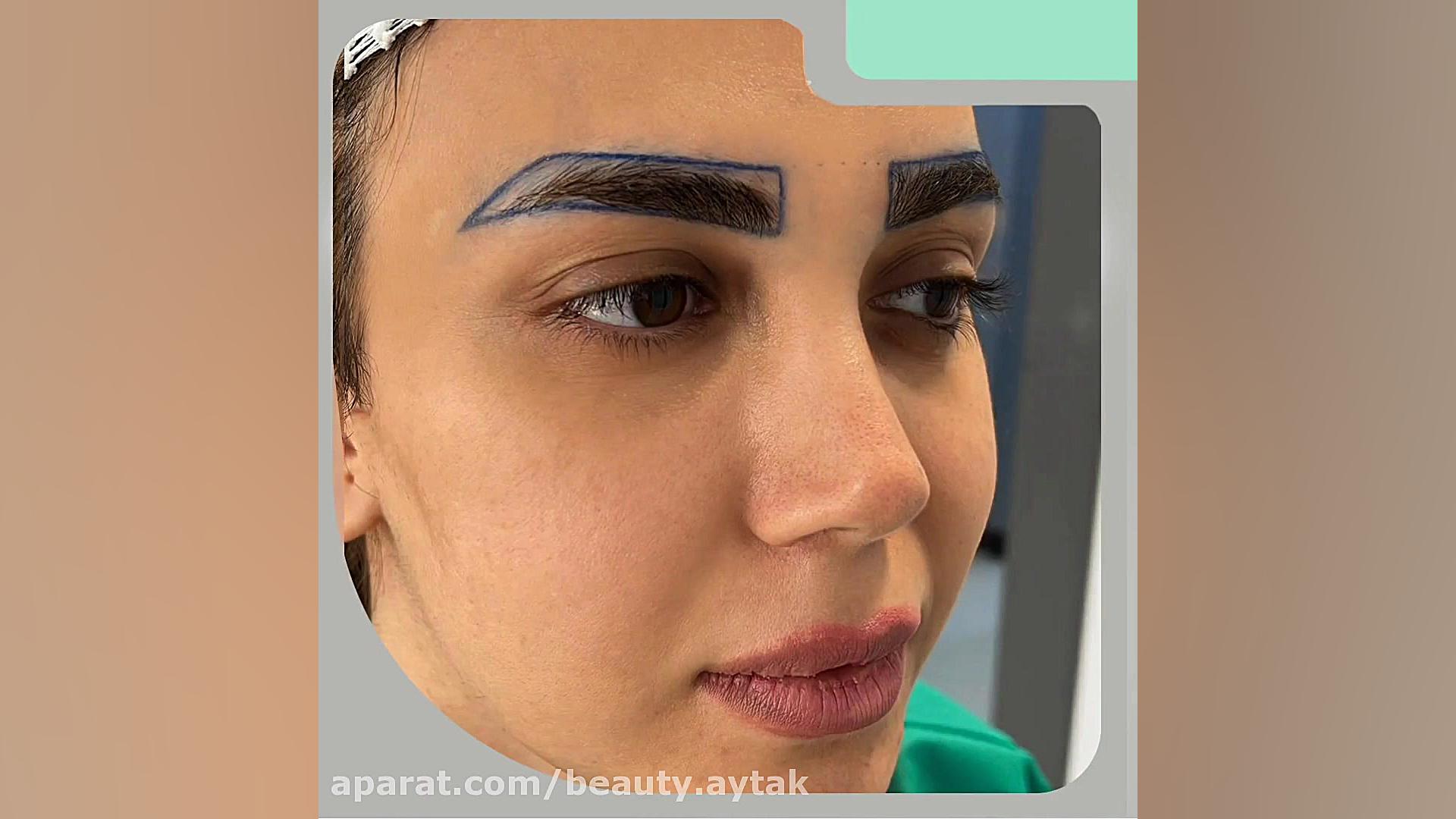 فیلم پیوند ابرو طبیعی | مرکز کاشت آیتک | ابرسانی پوست