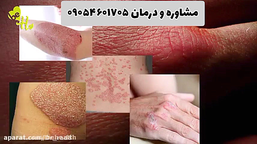 پسوریازیس در طب سنتی با دکتر خیراندیش درمان شد کمند امیرسلیمانی