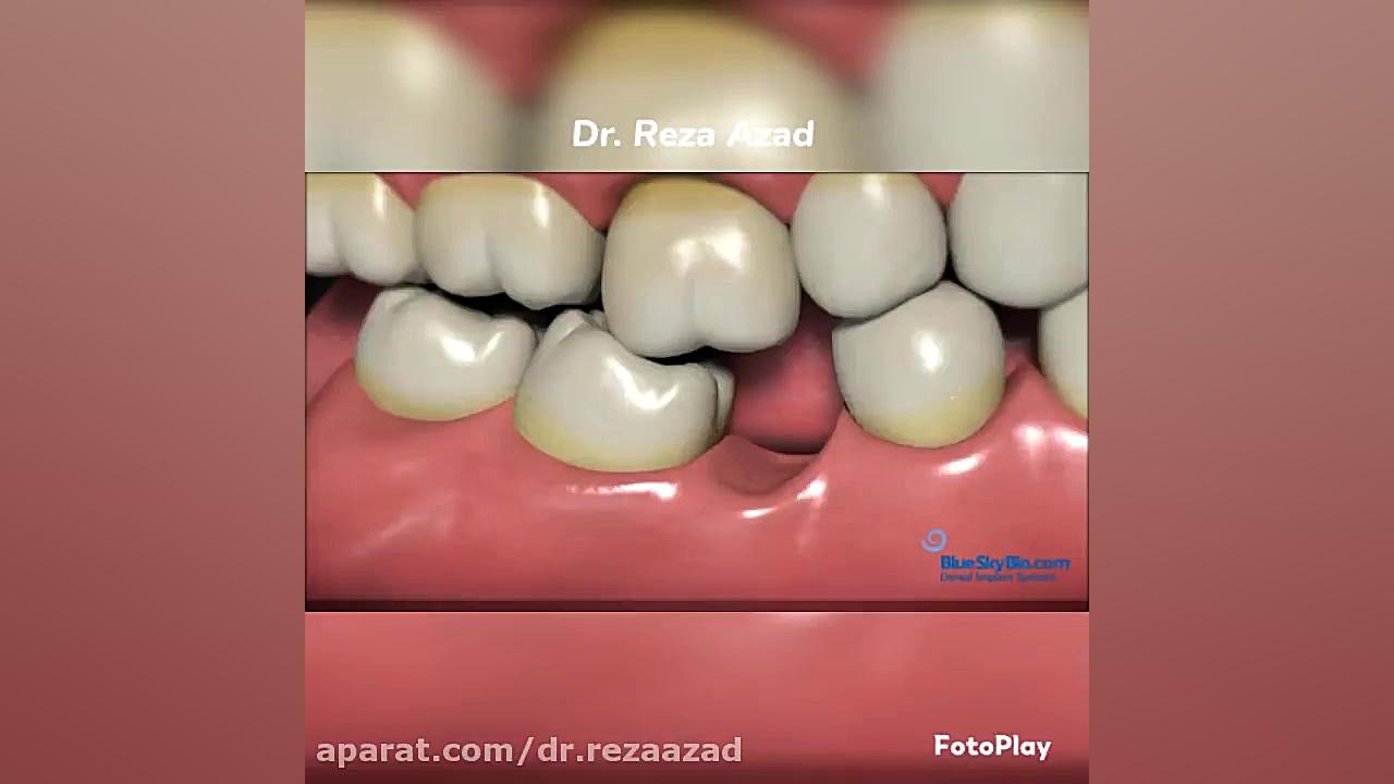 دکتر رضا آزاد: ایمپلنت دندانی و اهمیت آن، Implant and it's importance دکتر رضا آزاد