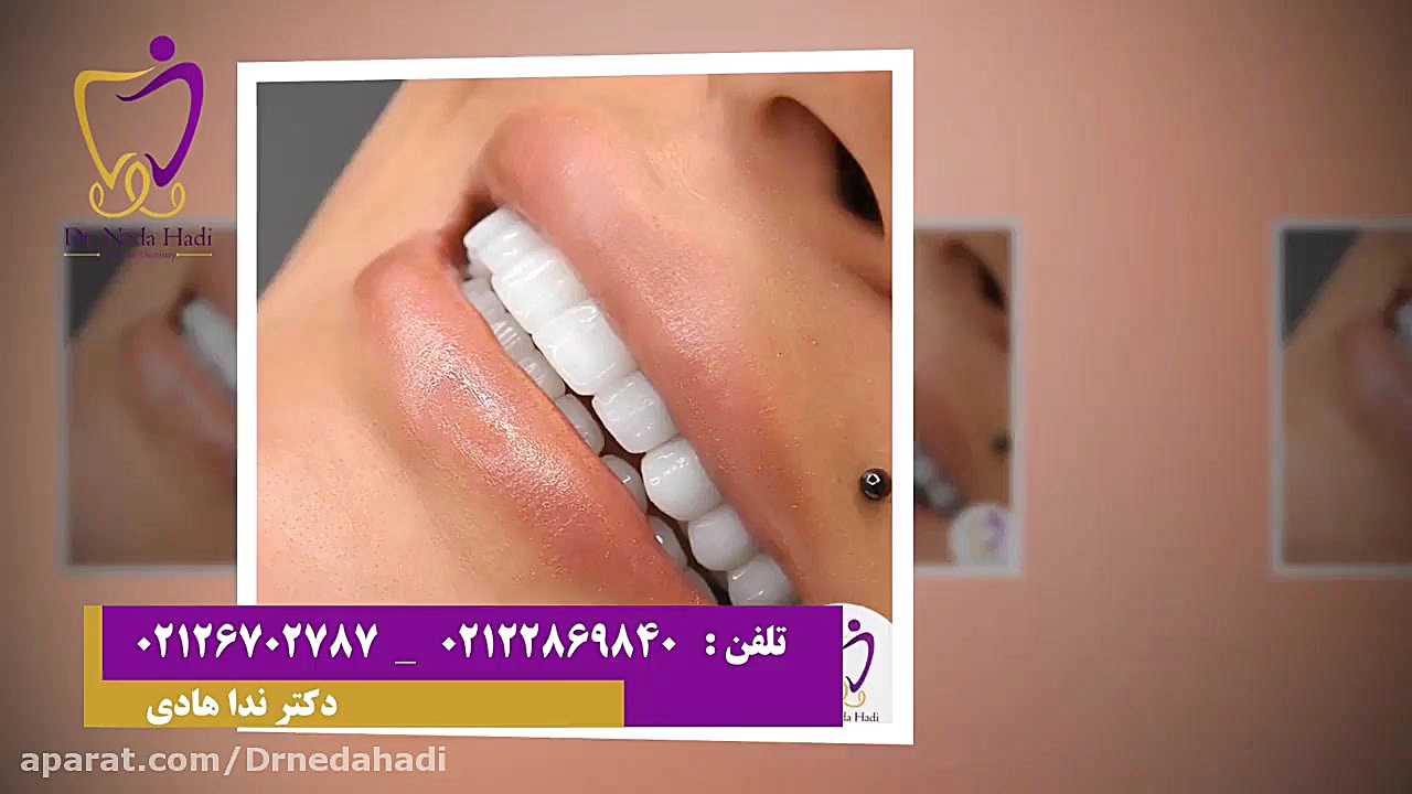 فیلم واقعی از انجام کامپوزیت دندان دکتر ندا هادی-دندانپزشک زیبایی