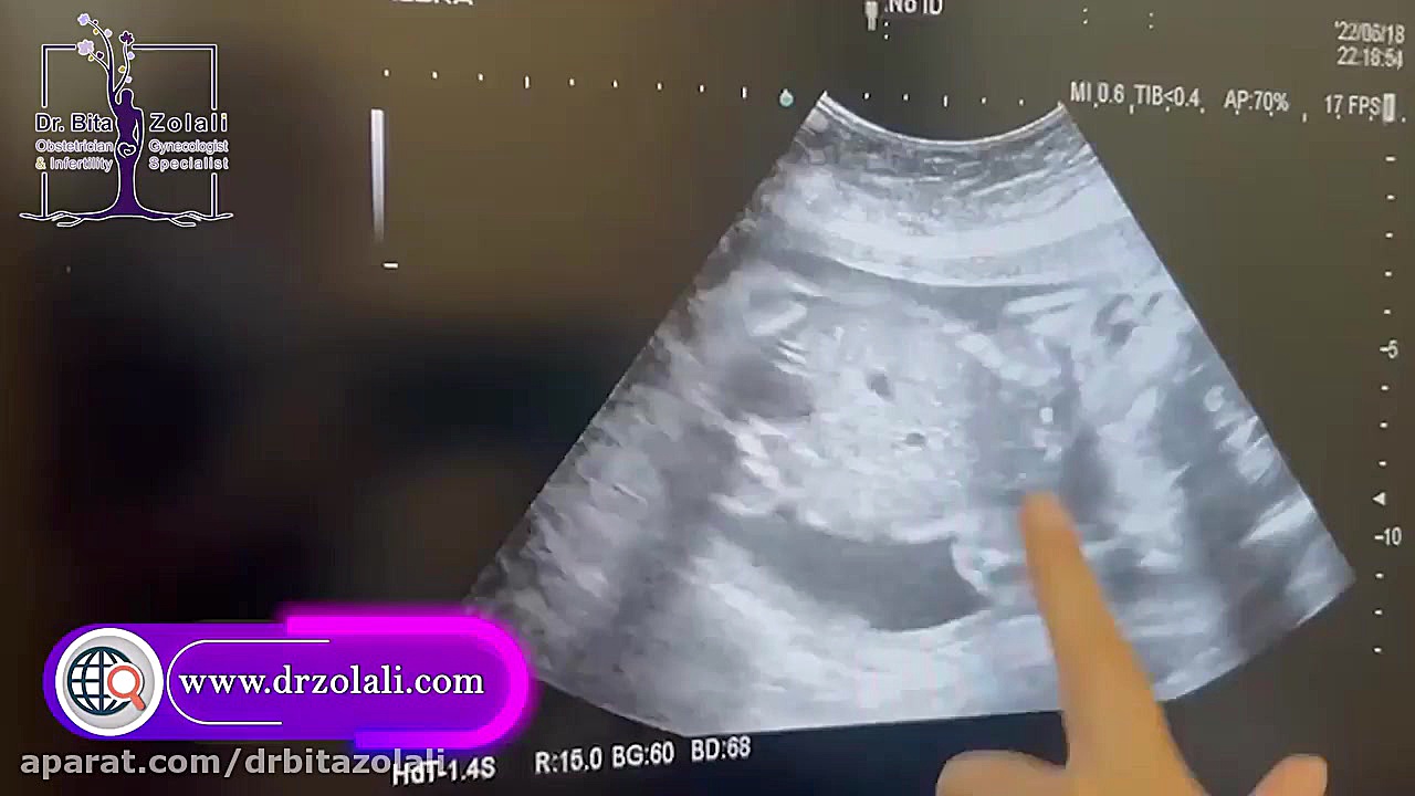 سونوگرافی جنین ۶ ماهه با سابقه نازایی و تعیین جنسیت همراه با ای وی اف تزریق ژل
