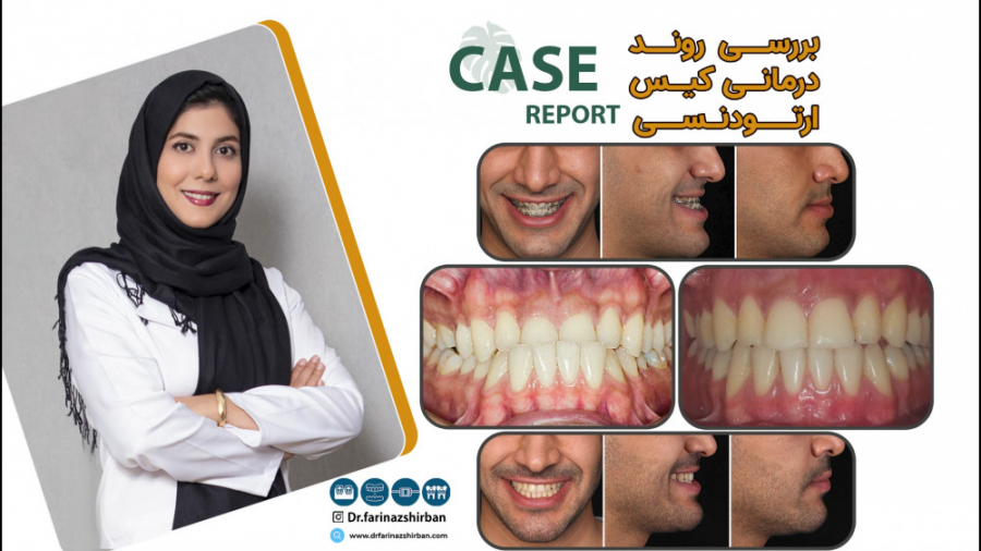 درمان ارتودنسی و جراحی فک | درمان بیمار کلاس سه | دکتر فریناز شیربان سندرم هرمون گیرنده مقاوم