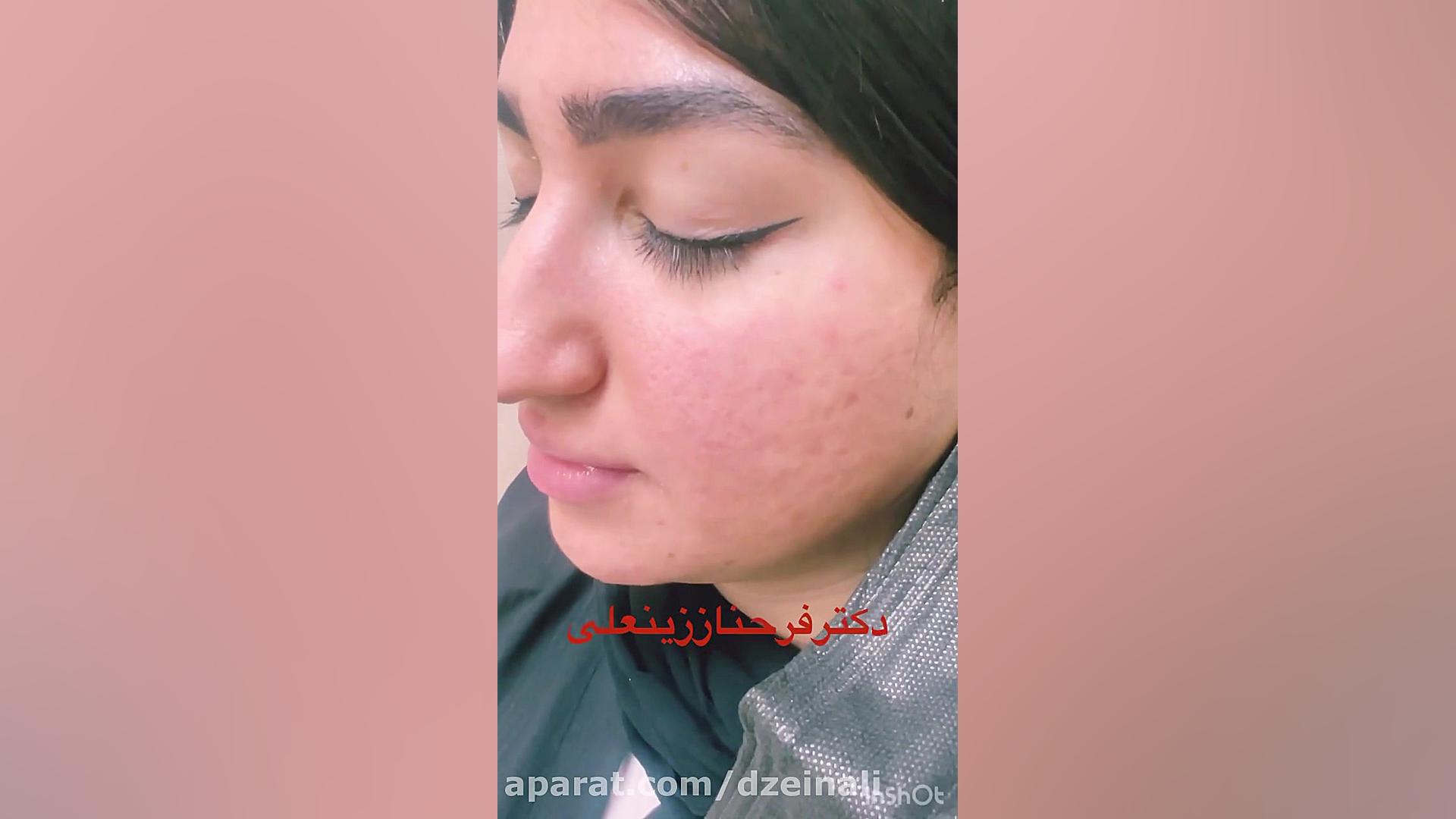 عکس قبل از شروع درمان و بعد از یک جلسه سابسیژن و دارو برای رفع اسکارهای آکنه دکتر فرحناز زینعلی - متخصص پوست، مو، زیبایی زنجان
