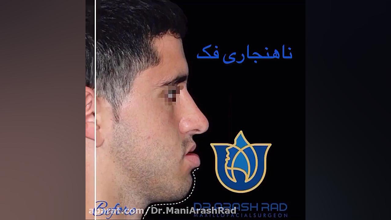 جراحی فک مزوتراپی
