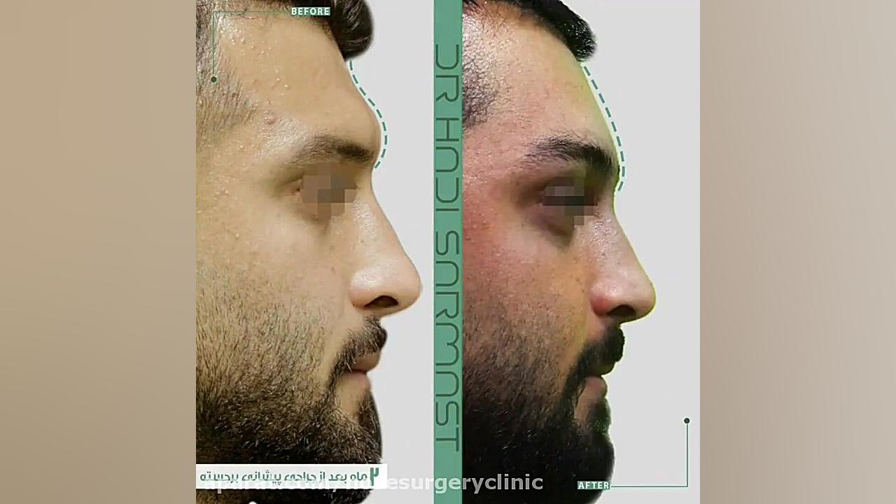 فیلم واقعی جراحی پیشانی برجسته مزوتراپی