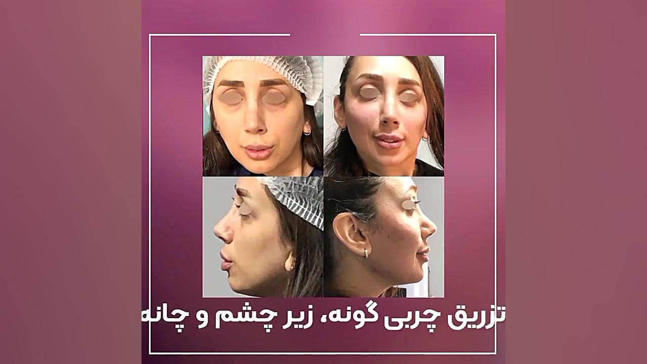 فیلم تزریق چربی گونه ، زیر چشم و چانه دکتر پریا صالحی ✔ بهترین جراح بینی تهران