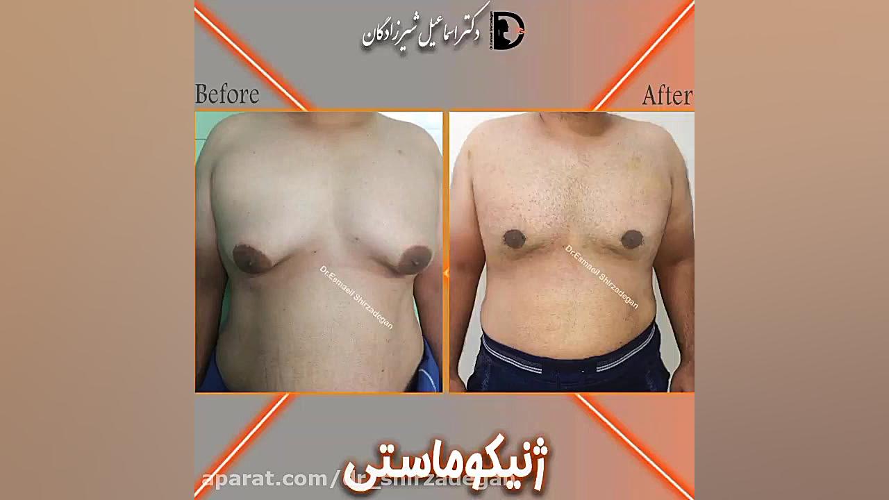 ژنیکوماستی دکتر اسماعیل شیرزادگان