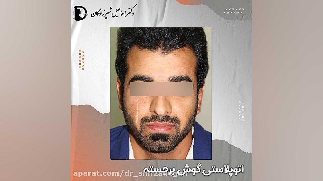 اتوپلاستی گوش برجسته دکتر اسماعیل شیرزادگان