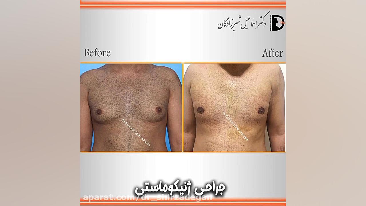 جراحی ژنیکوماستی دکتر اسماعیل شیرزادگان