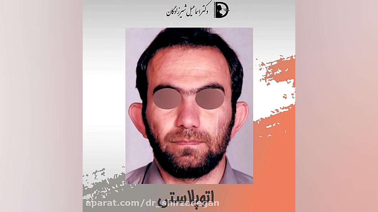 اتوپلاستی یا جراحی زیبایی گوش دکتر اسماعیل شیرزادگان