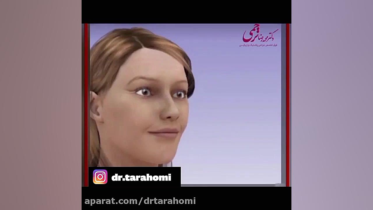 روش های بزرگ کردن چانه کاشت ریش