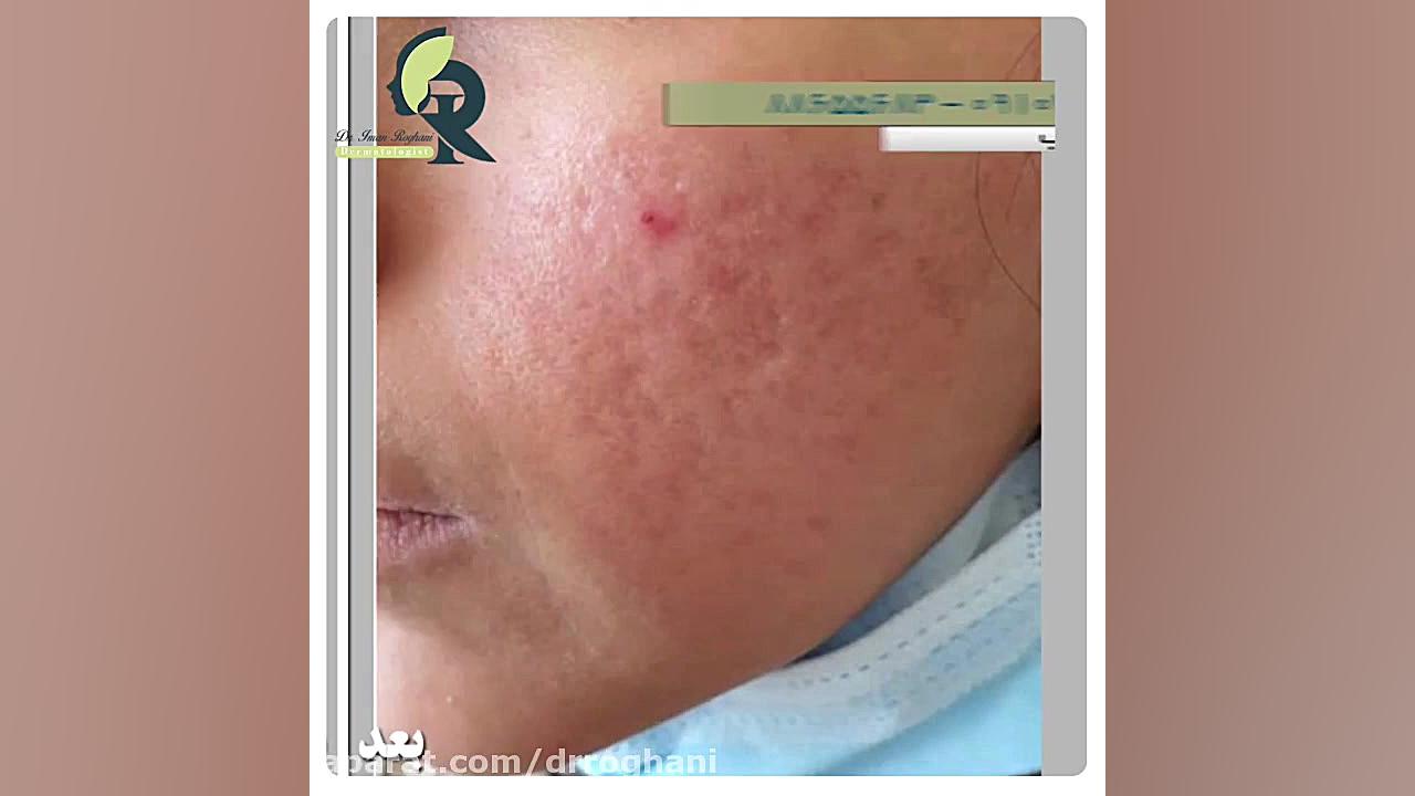 نتیجه یک جلسه کار ترکیبی سابسیژن و لیزر دکتر ایمان روغنی جراح و متخصص پوست و مو