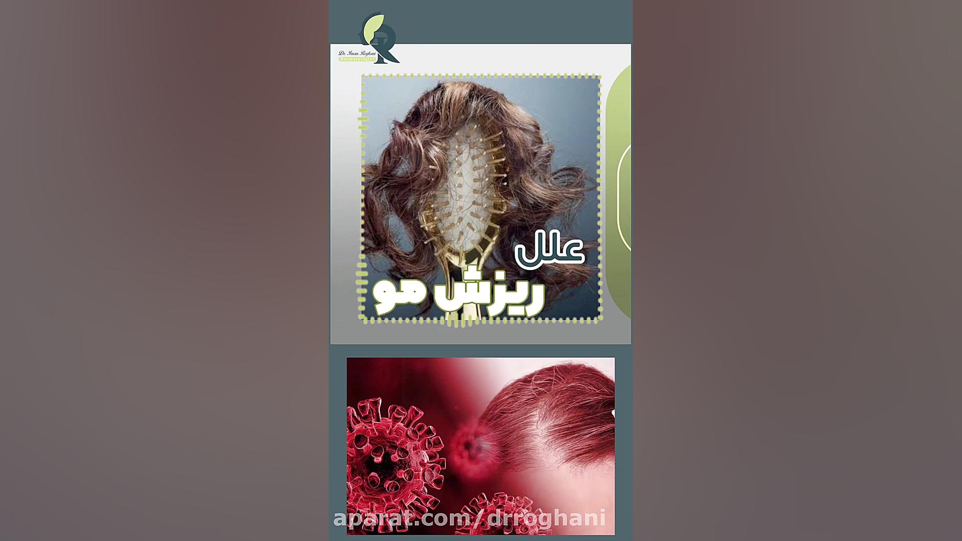 مهمترین علل ریزش مو دکتر ایمان روغنی جراح و متخصص پوست و مو