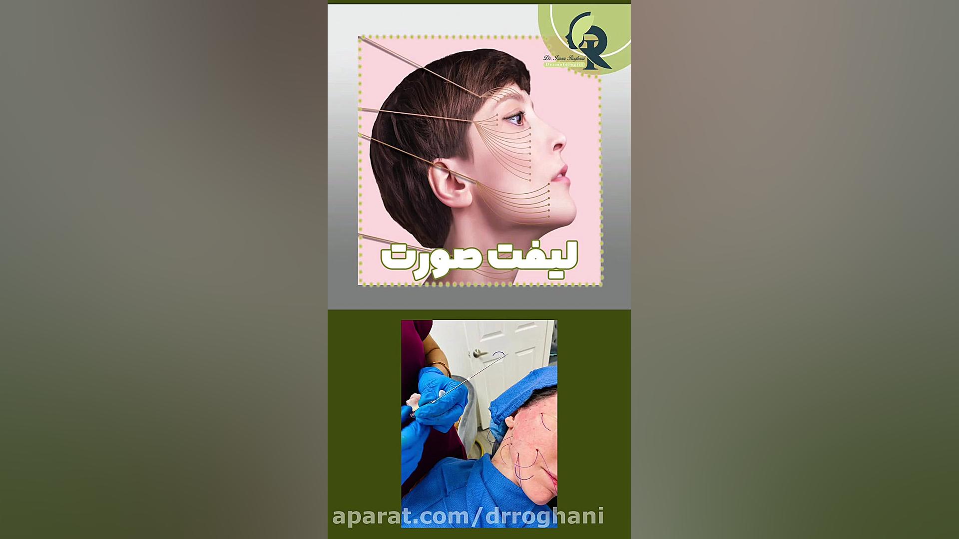 چه نوع لیفتی برای صورت شما مناسب است؟ دکتر ایمان روغنی جراح و متخصص پوست و مو