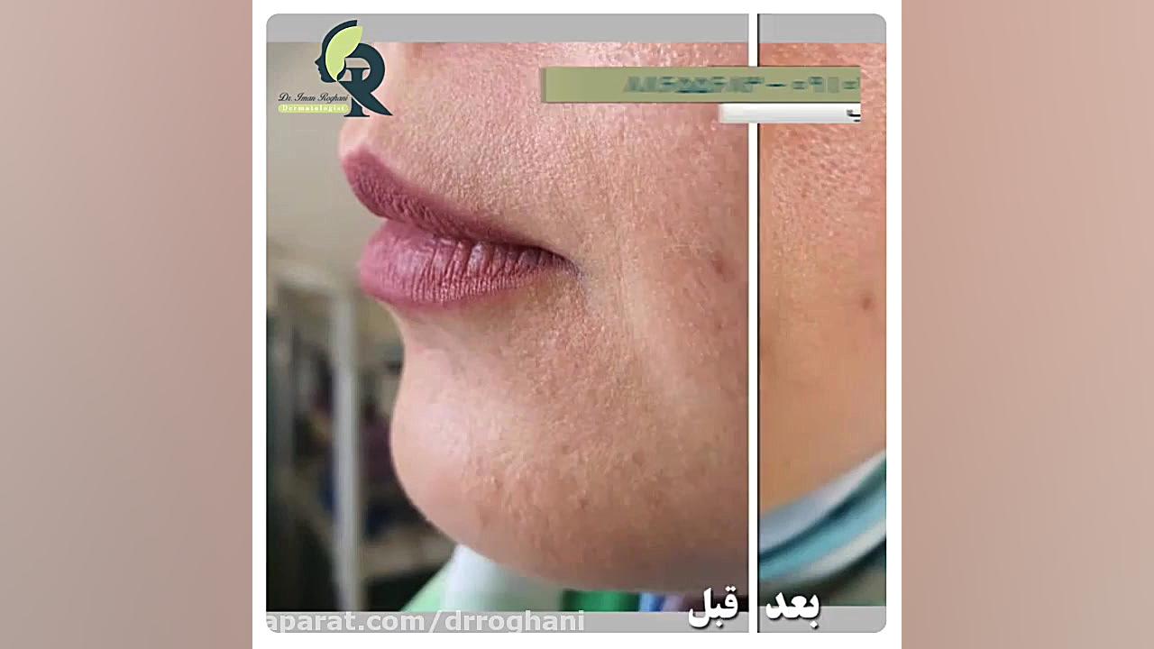 تزریق فیلر لب دکتر ایمان روغنی جراح و متخصص پوست و مو