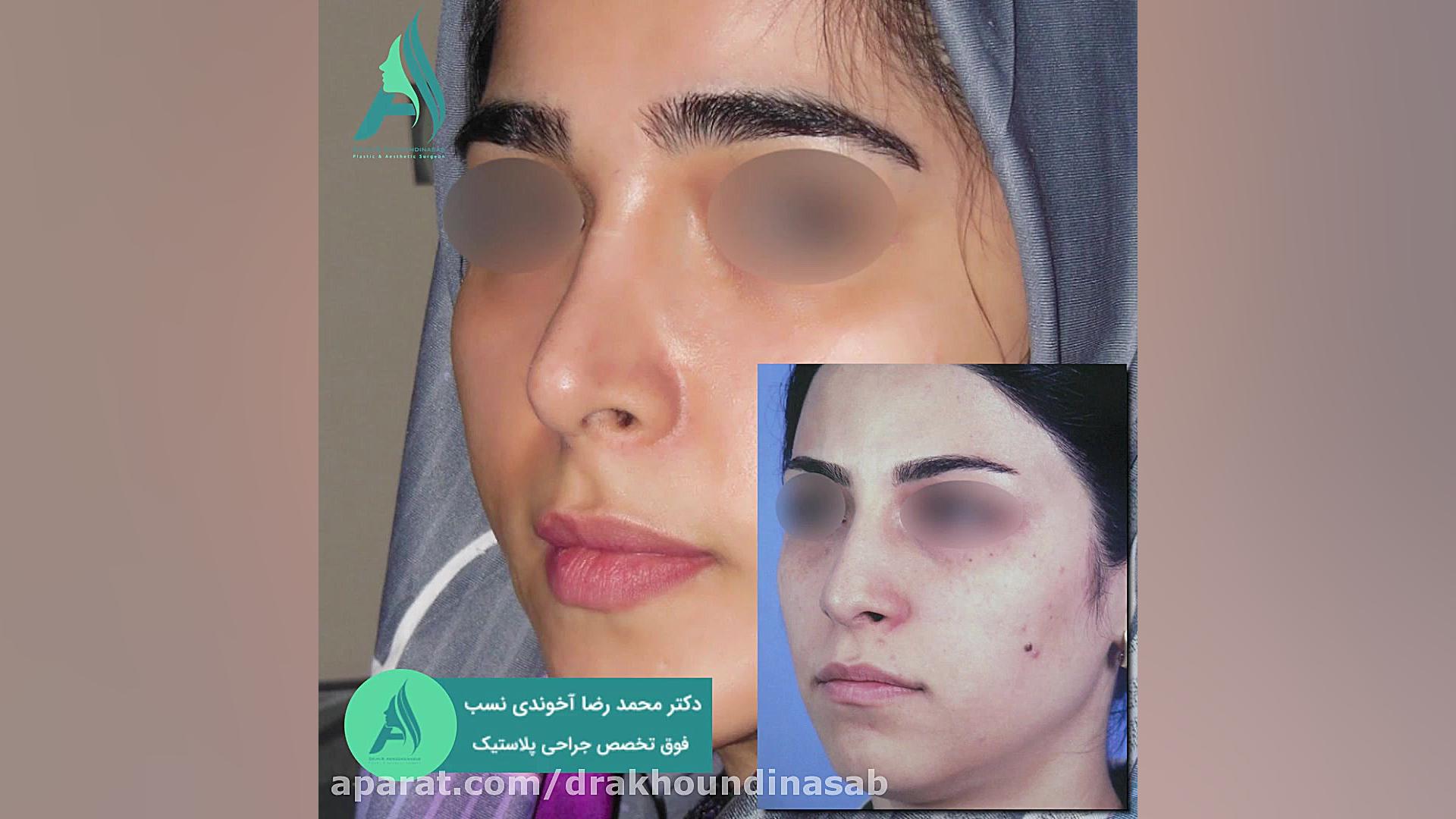 جراحی بینی استخوانی به صورت فانتزی دکتر محمدرضا آخوندی نسب-فوق تخصص جراحی پلاستیک