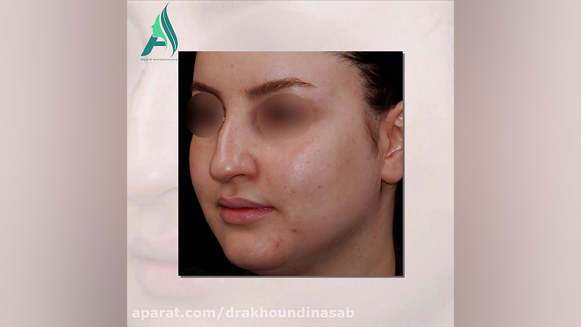جراحی بینی استخوانی به فرم طبیعی دکتر محمدرضا آخوندی نسب-فوق تخصص جراحی پلاستیک