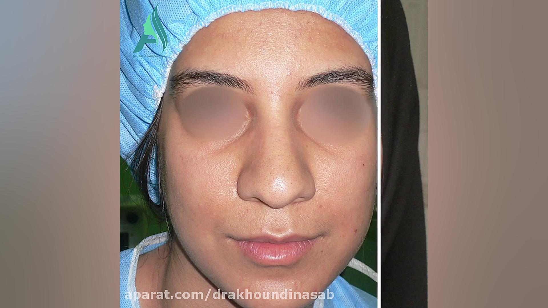 جراحی بینی گوشتی به فرم طبیعی دکتر محمدرضا آخوندی نسب-فوق تخصص جراحی پلاستیک