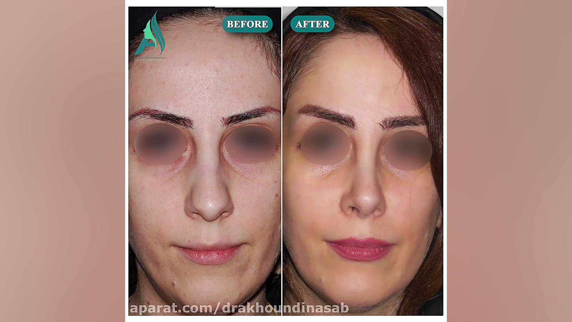 جراحی بینی استخوانی به صورت نیمه فانتزی دکتر محمدرضا آخوندی نسب-فوق تخصص جراحی پلاستیک